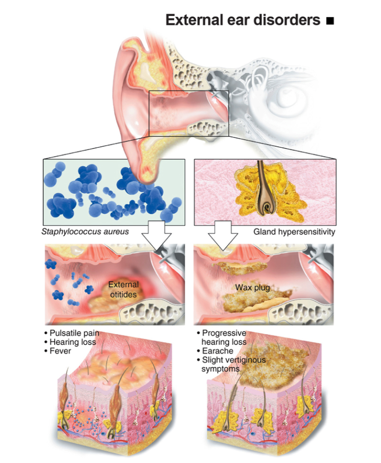 External Ear Disorder
