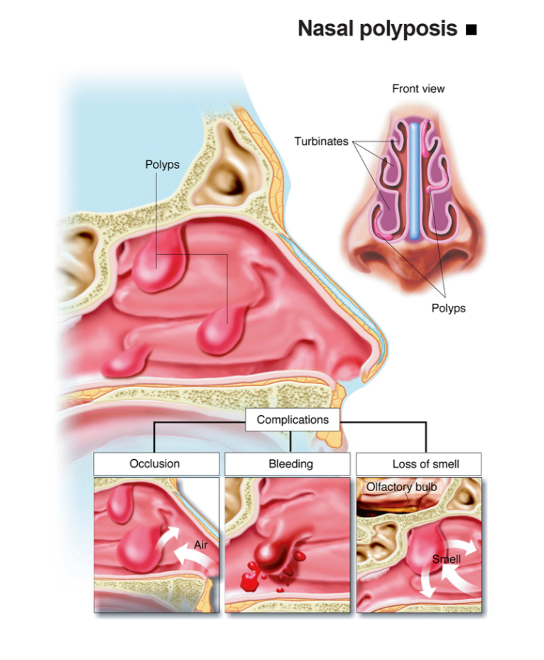Nasal Polyps