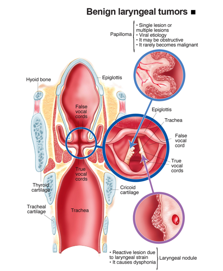 Benign Laryngeal Tumors